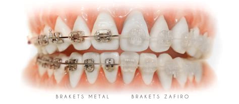 brackets de zafiro o metalicos|brackets de zafiro metal.